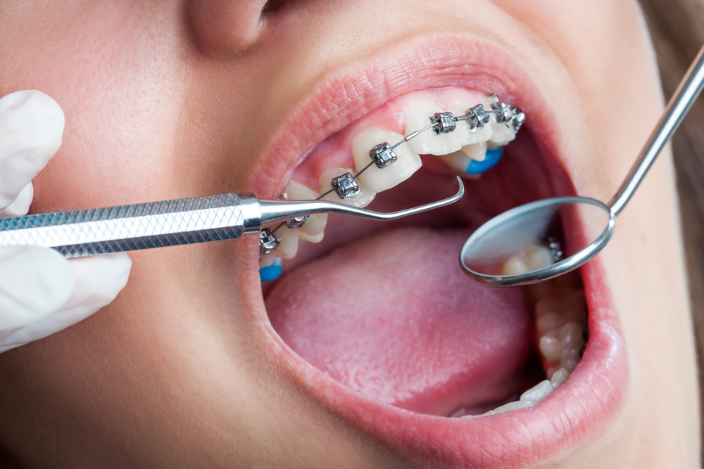 HomeTeethStraightening